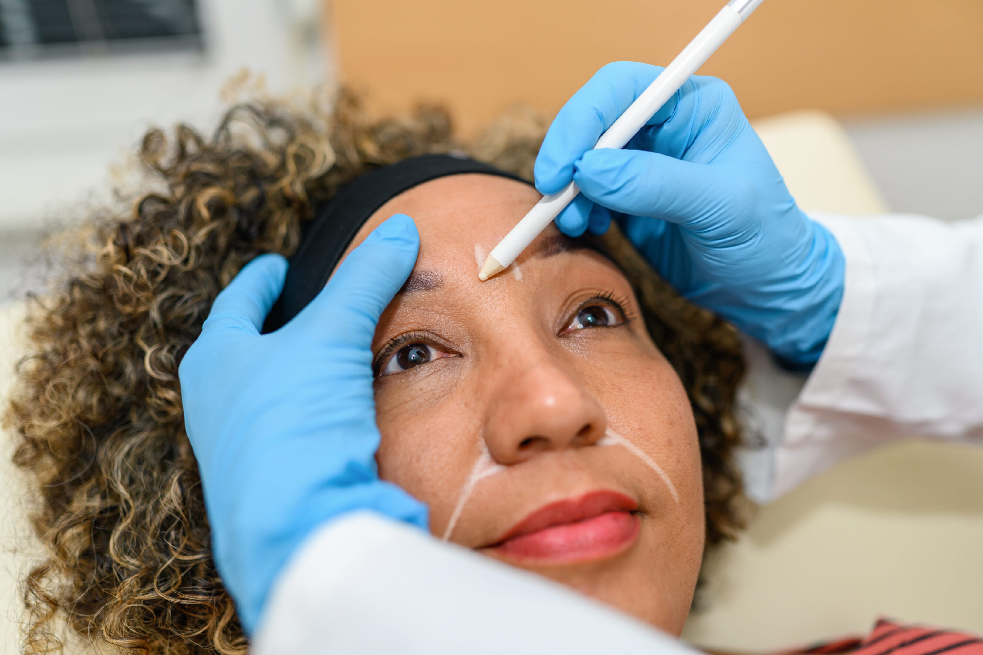 Woman's face marked before cosmetic procedure.