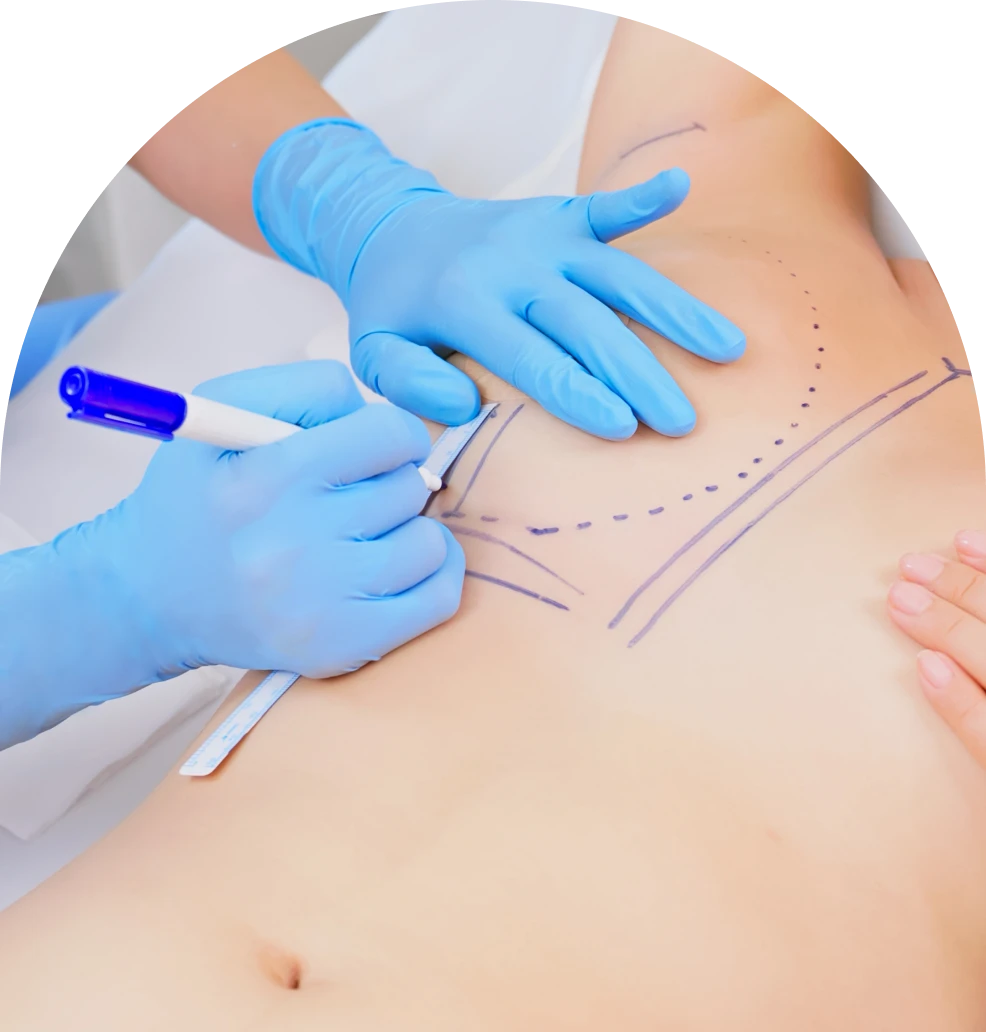 Plastic surgery markings on patient's body.