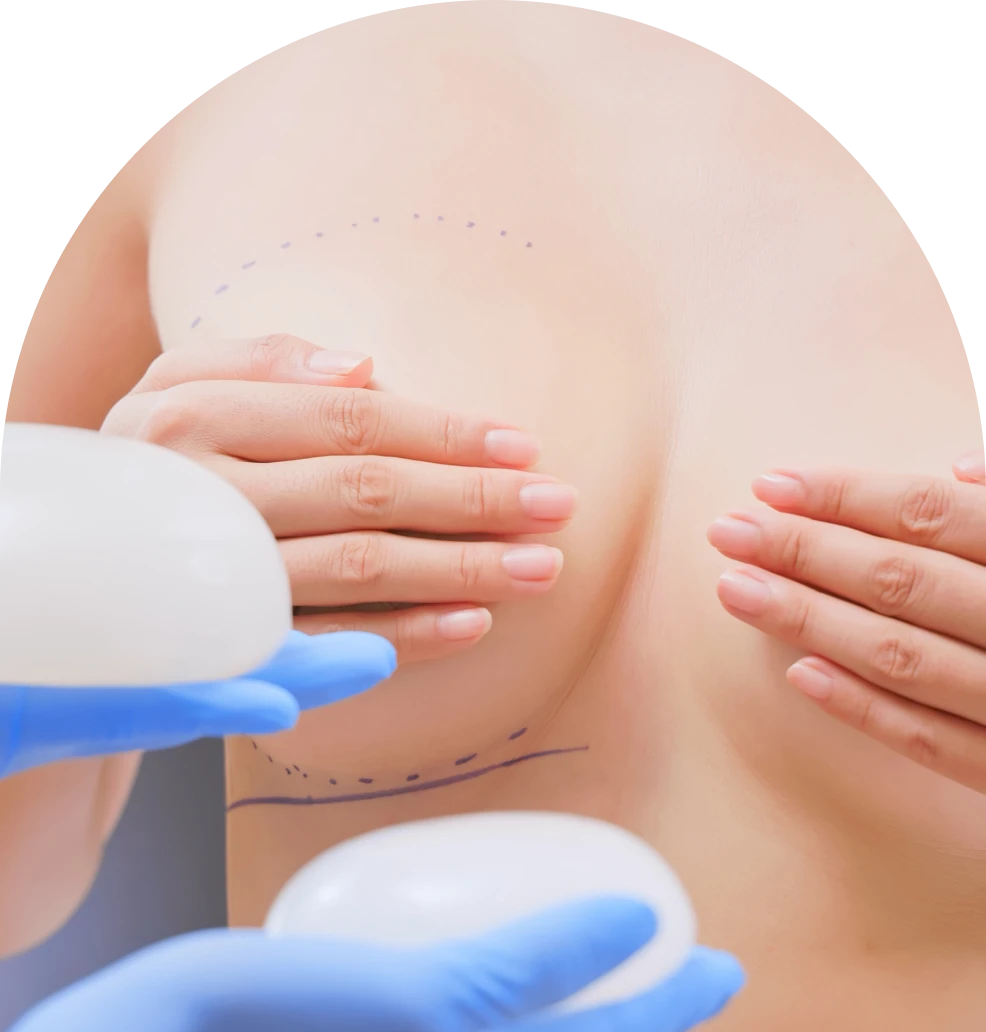 Breast augmentation consultation with implants.