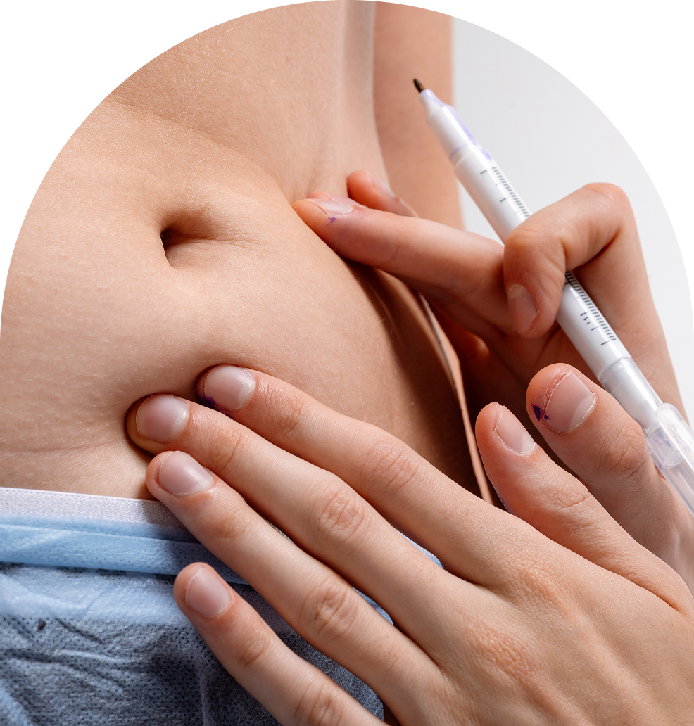 Marking skin for cosmetic surgery procedure.
