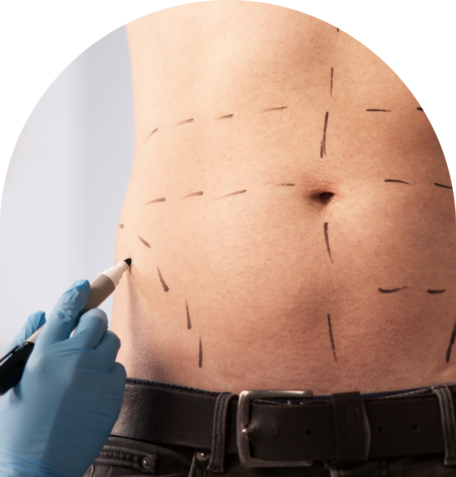 Marked torso with surgical guidelines, gloved hand.