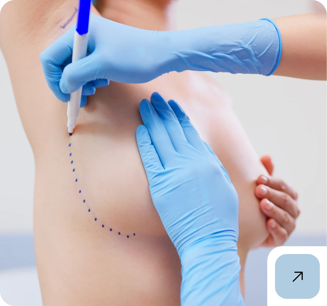Medical professional marking patient's breast for surgery.