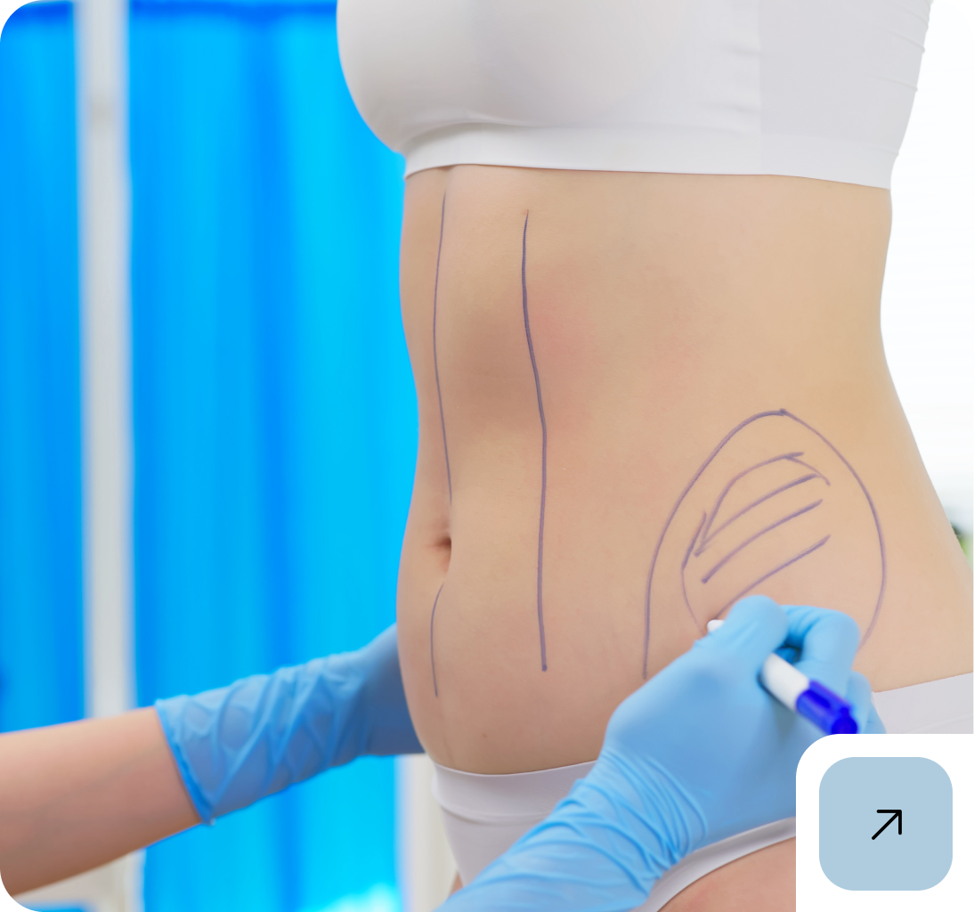Pre-surgery markings on woman's stomach